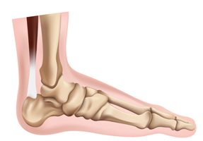 Corns, Calluses and Bunions Treatment