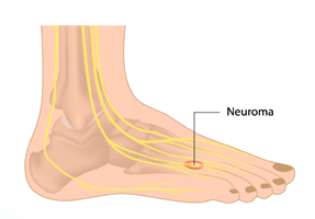 Morton’s Neuroma Treatment