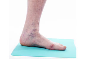 Varicose Veins Treatment